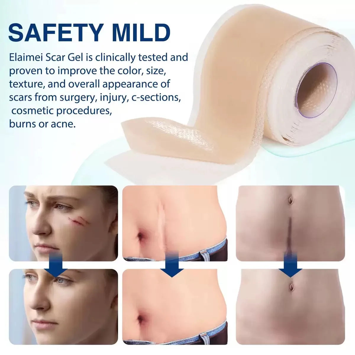 Silicone Scar Sheet – Reusable Silicone Scar Tape